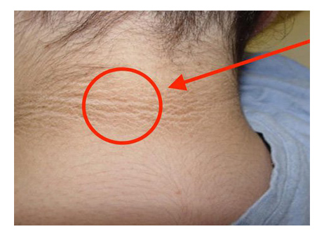 Vấn đề về da do bệnh tiểu đường