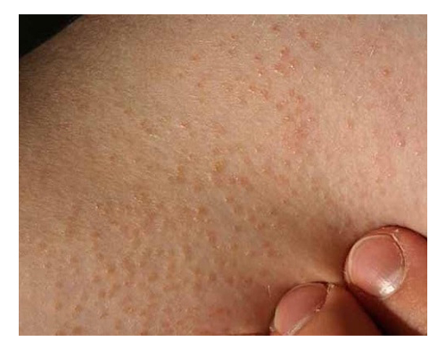 6 dấu hiệu cảnh báo xuất hiện trên da báo hiệu bệnh tiểu đường