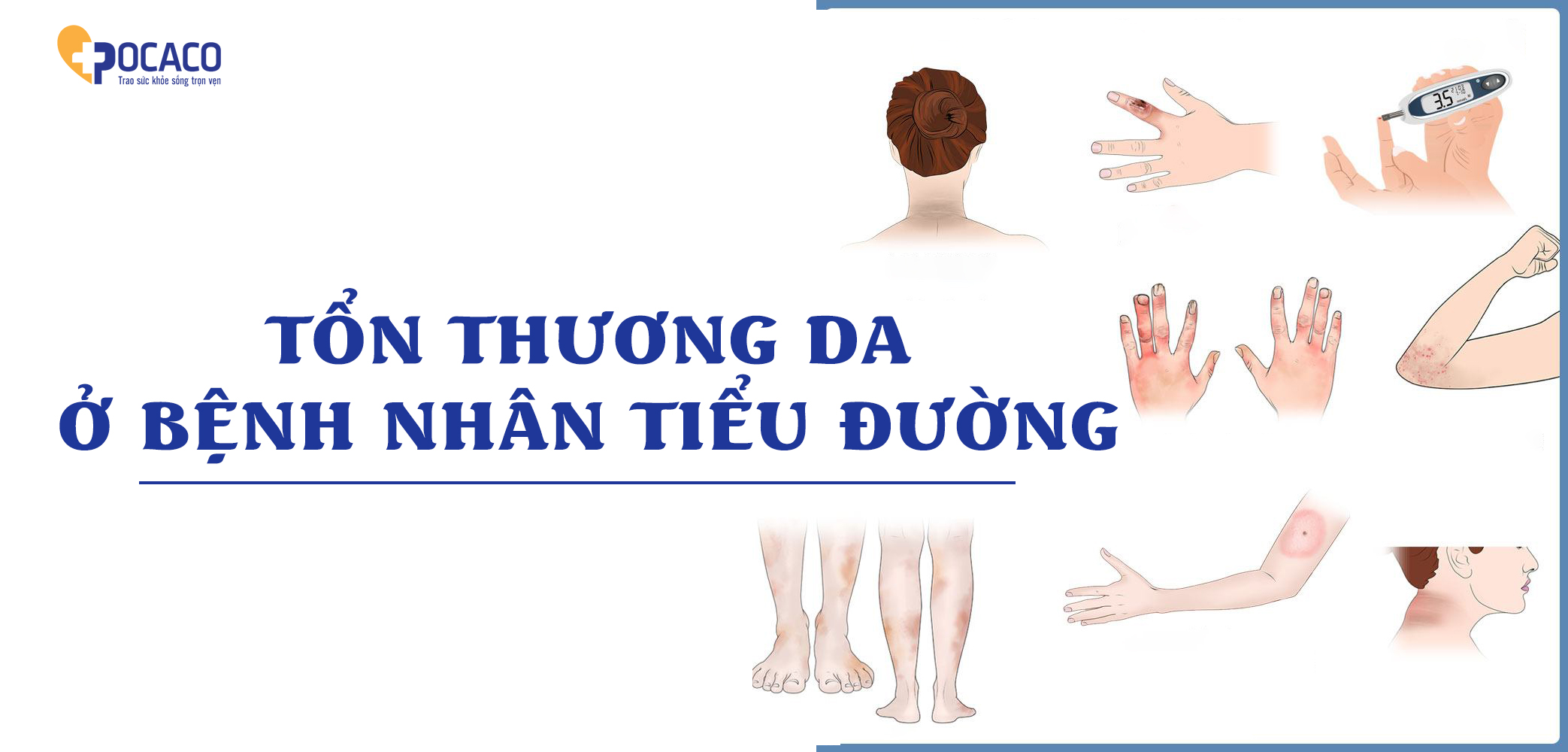 ton-thuong-da-o-benh-nhan-tieu-duong-1