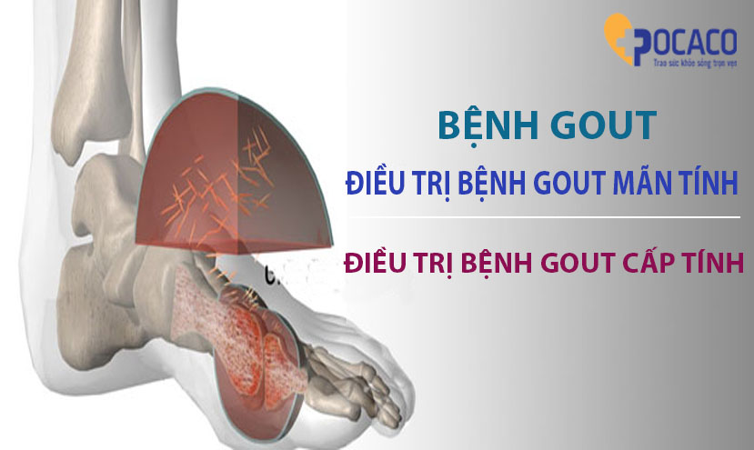 dieu-tri-benh-gout-man-tinh-benh-gout-cap-tinh-1