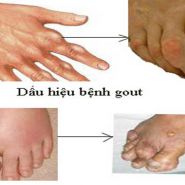 Phác đồ điều trị bệnh gout theo hướng phục hồi và tăng cường