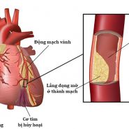 Thuốc điều trị tiểu đường type 2 được kê đơn theo độ bệnh