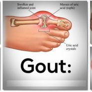 Gout cấp tính và những hướng dẫn điều trị bệnh Gout đúng cách
