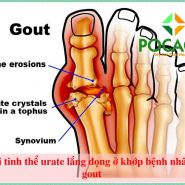 Tiêu chí tìm phương pháp điều trị gout như thế nào là phù hợp